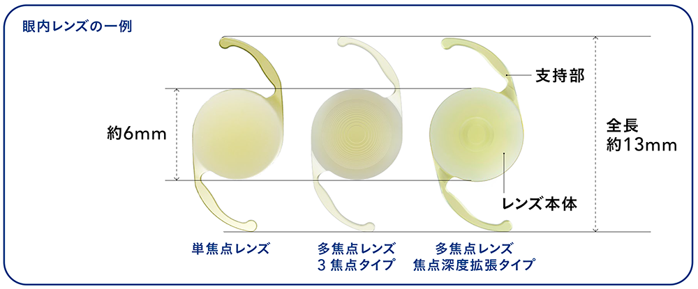 眼内レンズって、どんなレンズなの?